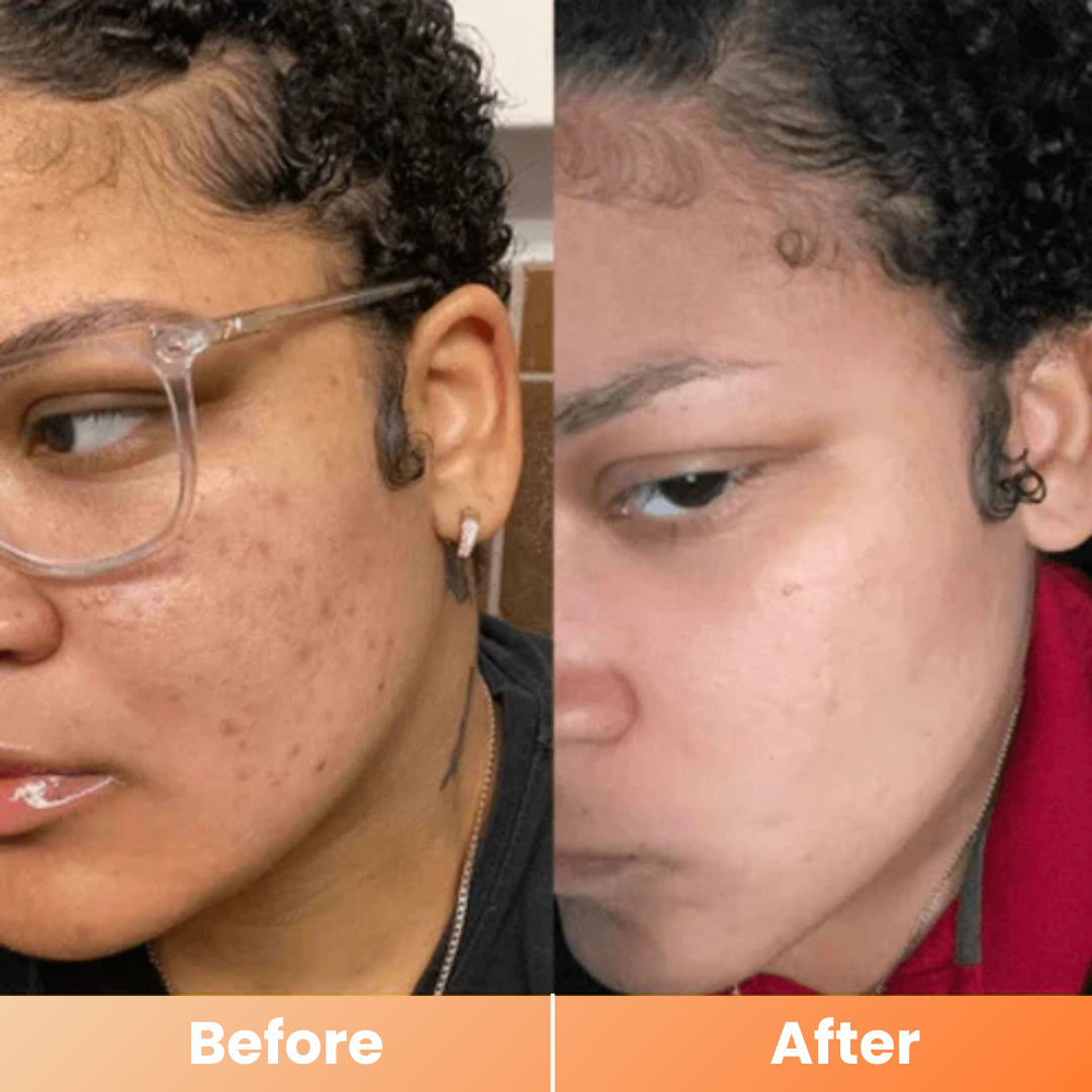 Dr.Melaxin® Peel Shot | Exfoliating Kojic Acid Turmeric Spray 200ml