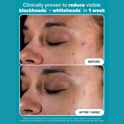 Paula’s Choice SKIN PERFECTING 2% BHA Liquid Exfoliant