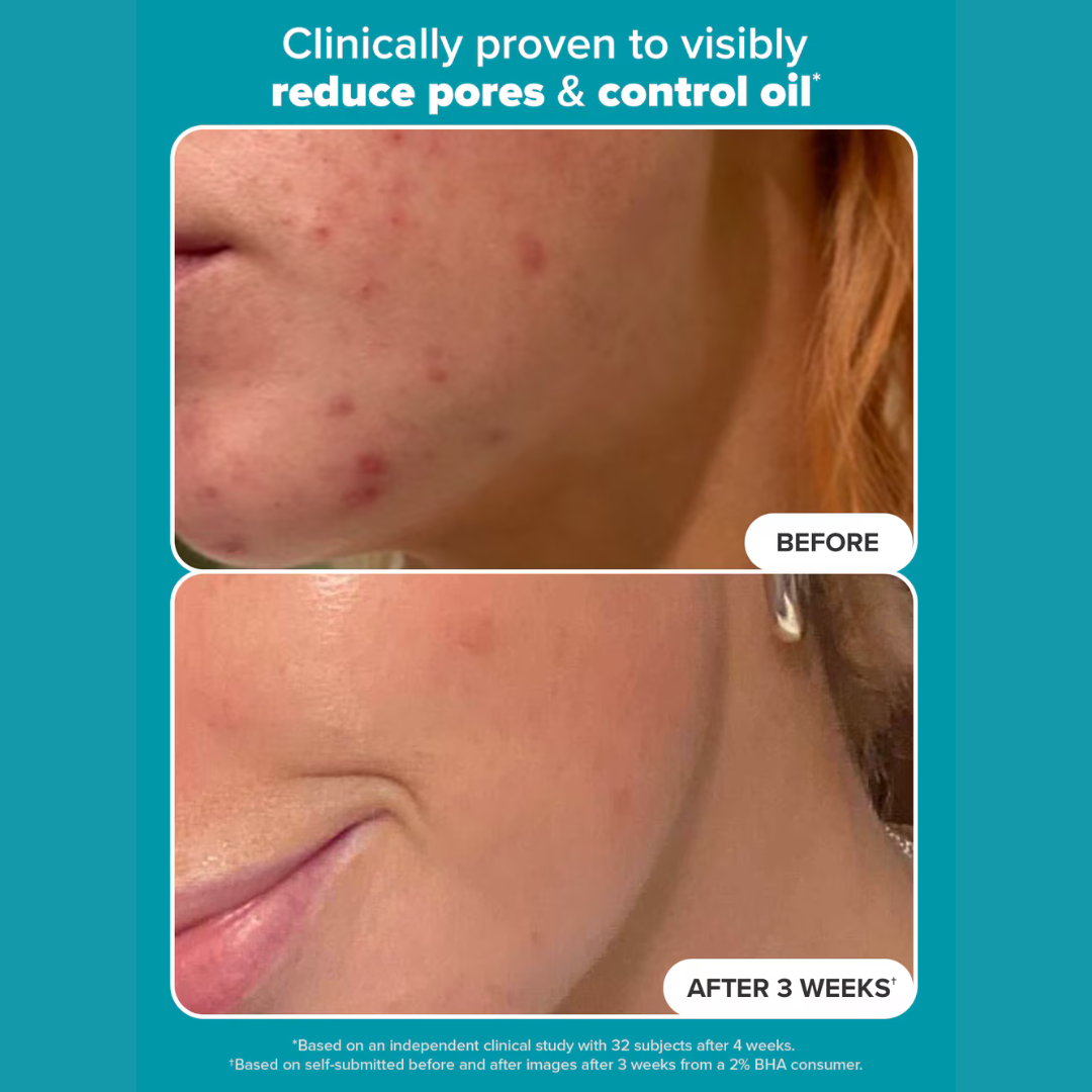 Paula’s Choice SKIN PERFECTING 2% BHA Liquid Exfoliant