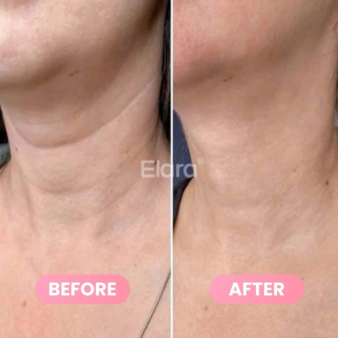 Medicube® PDRN Collagen Gua Sha Neck Wrinkle Cream 90g