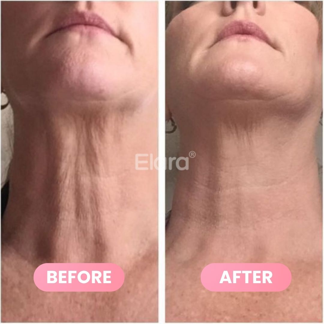 Medicube® PDRN Collagen Gua Sha Neck Wrinkle Cream 90g